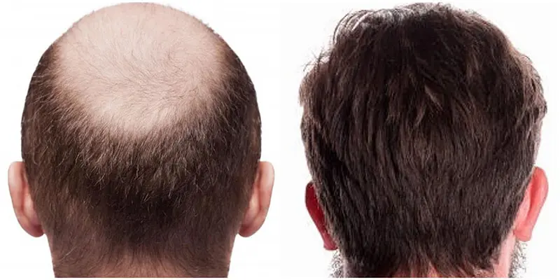 calvitie chute de cheveux traitements solutions nice cannes perte alopecie
