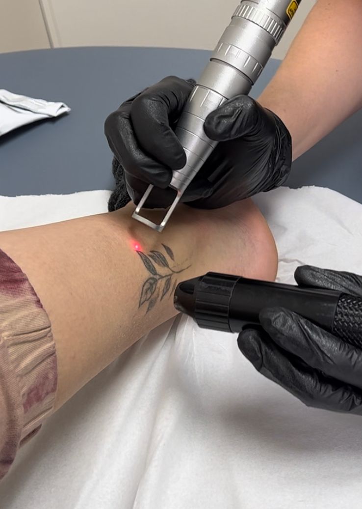 éliminer un tatouage rapidement avec le laser à cannes