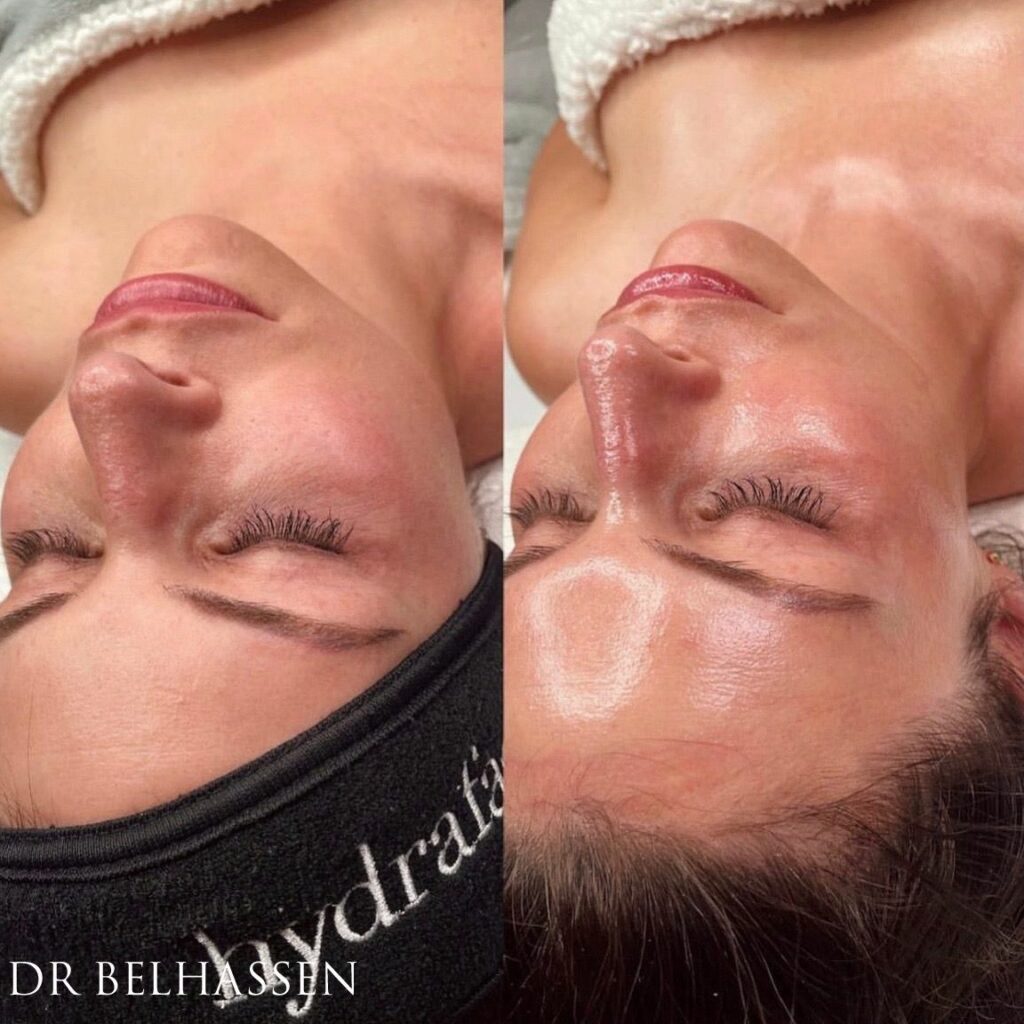 résultats après une séance d'hydrafacial