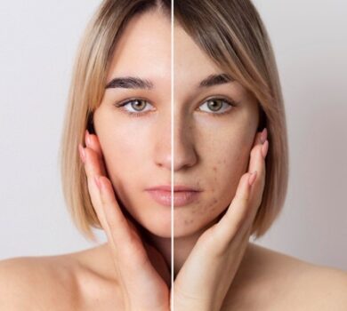 comment traiter acne post ete saison estivale traitement dermatologue peelings soins cannes nice esthetique