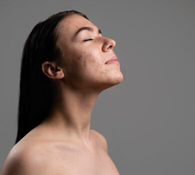 visage de jeune femme avec cicatrices d'acne et boutons d'acne